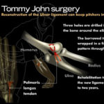 What Pitchers Need to Know About Tommy John Surgery