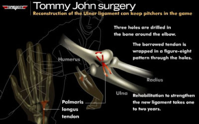Does Tommy John Surgery Make You Throw Harder?