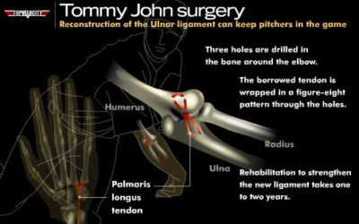 Does Tommy John Surgery Make You Throw Harder?