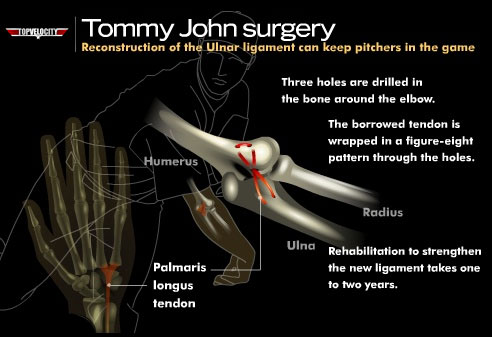 What Pitchers Need to Know About Tommy John Surgery