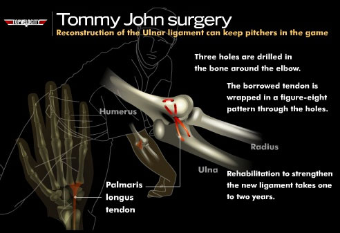 Does Tommy John Surgery Make You Throw Harder?