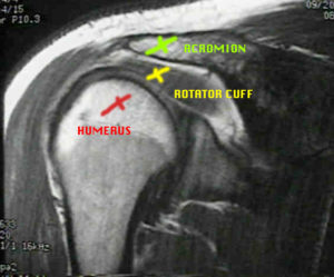 Rotator Cuff Impingement