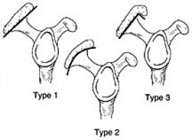 Shoulder Impingement Types