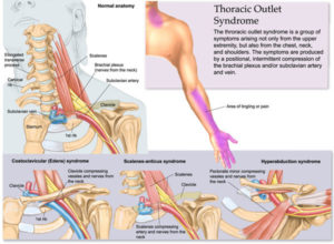 Thoracic Outlet Syndrome Prevention Pitchers