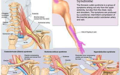Thoracic Outlet Syndrome Prevention for Pitchers