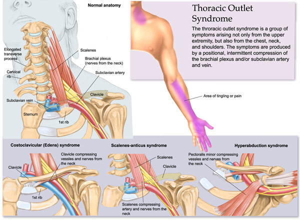 Thoracic Outlet Syndrome Prevention for Pitchers