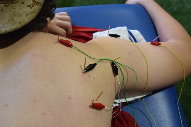 Dry Needling for The Throwing Athlete Increase Pitching Velocity