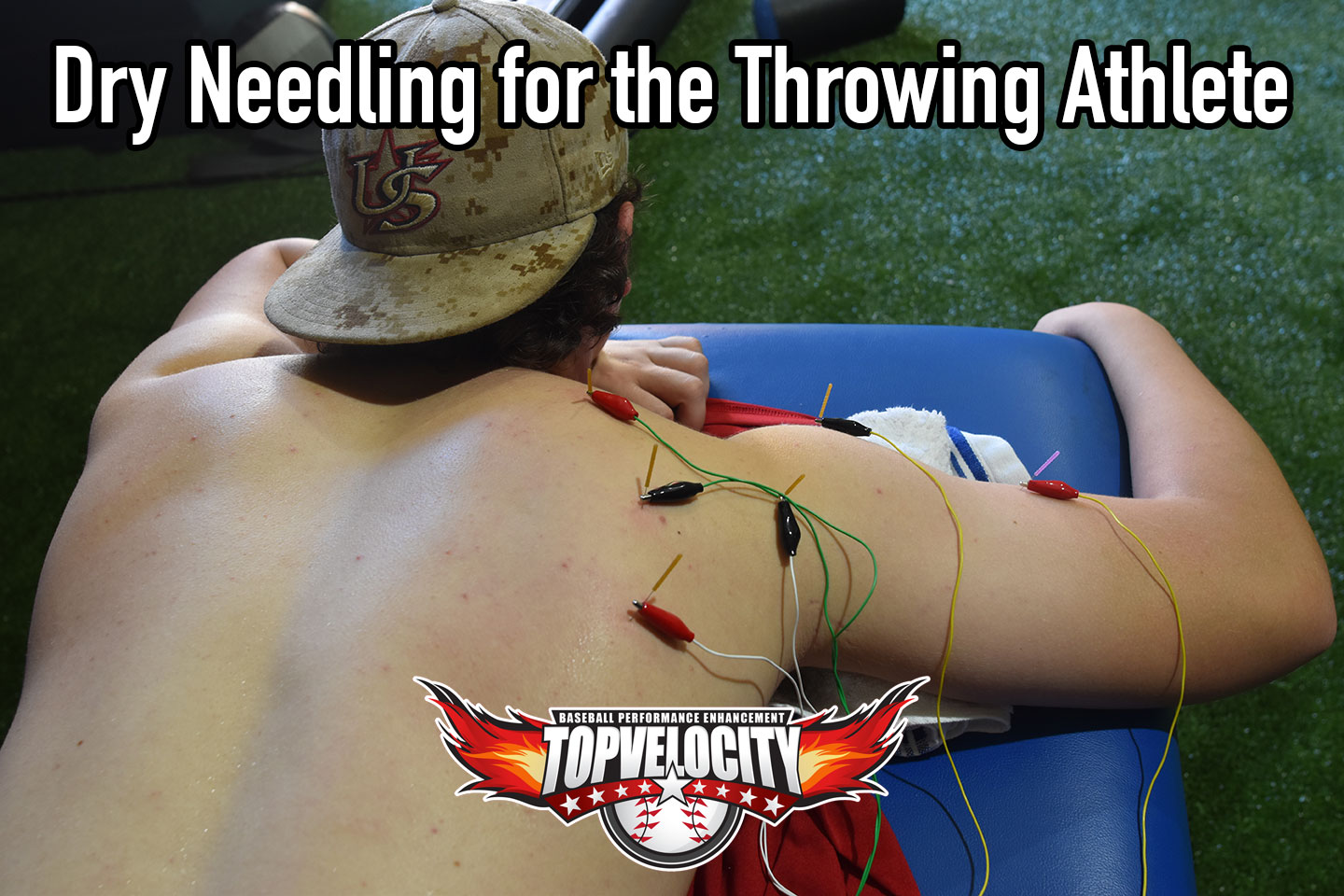 Dry Needling for The Throwing Athlete Increase Pitching Velocity Dry Needling for The Throwing Athlete Increase Pitching Velocity