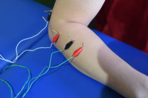 dry needling