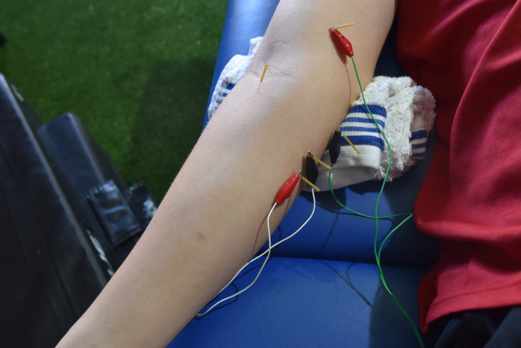 Dry Needling for The Throwing Athlete Increase Pitching Velocity