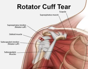 Throw With a Torn Rotator Cuff